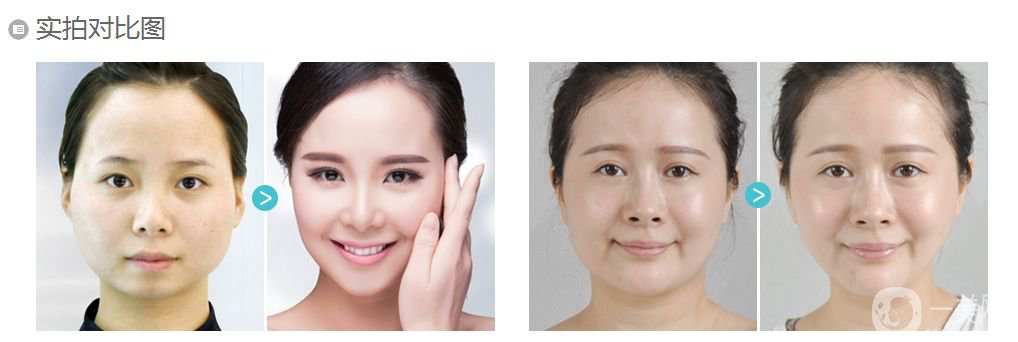 微創(chuàng)改臉型多少錢 改臉型的壞處