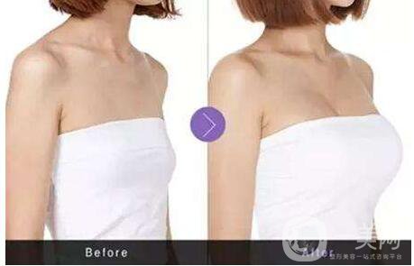 妙桃隆胸的價格 妙桃隆胸*果怎么樣