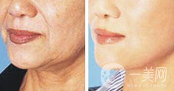 拉皮多少錢,拉皮除皺價(jià)格