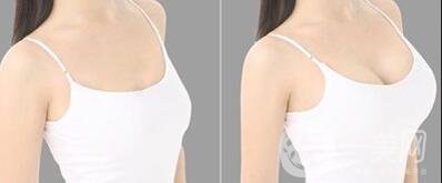 假體豐胸手術(shù)費(fèi)用,假體豐胸多少錢