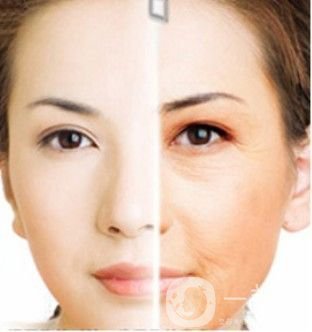 prt是什么 是電波拉皮嗎？