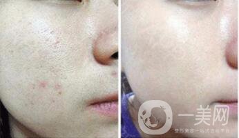 果酸換膚后注意事項 果酸換膚手術(shù)*果如何