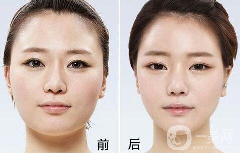 墊下巴用什么材料好 墊下巴的方法