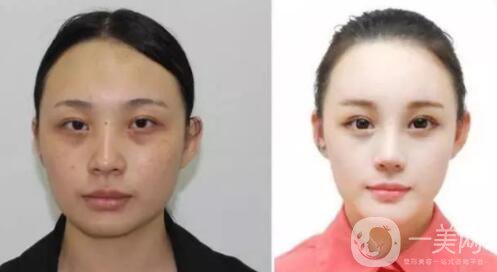 光子嫩膚的優(yōu)勢 光子嫩膚有風(fēng)險(xiǎn)嗎？