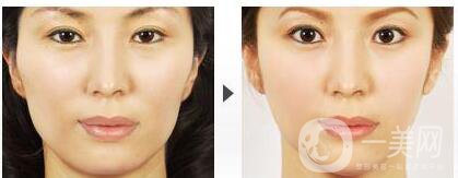 磨下頜角價(jià)格是多少呢 下頜角整形價(jià)格介紹一覽