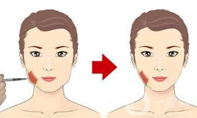 下頜角磨削多少錢 怎么選擇醫(yī)院醫(yī)生