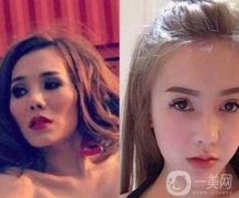 女子被前男友嫌丑 怒花12萬整容成美女