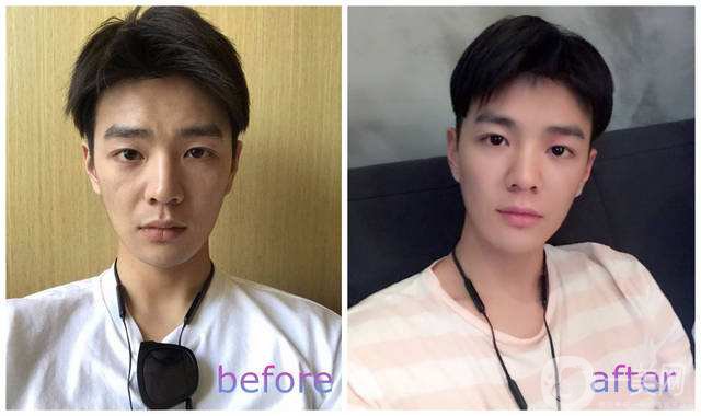 自體脂肪可以填充淚溝嗎？手術*果好不好？