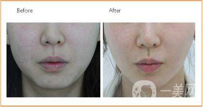 抽脂和溶脂有什么區(qū)別 抽脂和溶脂的原理