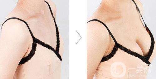 假體豐胸多久才不會硬 多久會變軟？