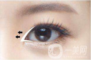 雙眼皮開眼角*嗎 開眼角要恢復多久