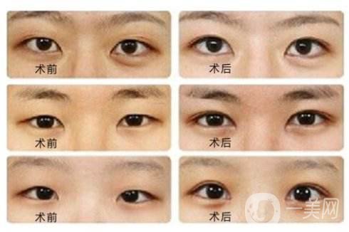 雙眼皮開眼角*嗎 開眼角要恢復多久