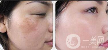 *之心激光祛斑*果