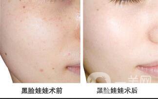 鐳射黑臉娃娃,鐳射黑臉娃娃*果,鐳射黑臉娃娃價格