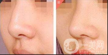 駝峰鼻矯正方法,駝峰鼻矯正注意事項(xiàng)