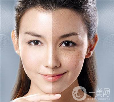 c6激光祛斑多少錢 激光祛斑*果怎么樣