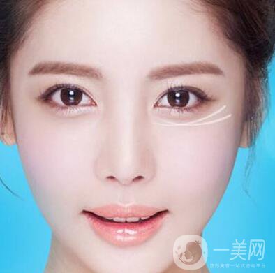 注射去皺后時(shí)間久了皺紋會(huì)變得更糟嗎？