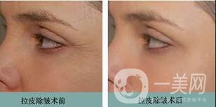 拉皮手術(shù)費用,拉皮多少錢