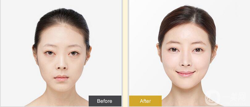 開內(nèi)外眼角*果如何？開眼角前后照片