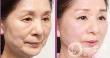 除皺多少錢 除皺的方法有哪些