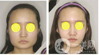 削骨瘦臉多少錢,削骨瘦臉*果