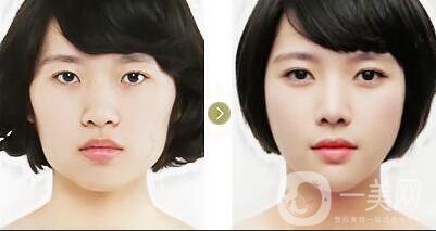 臉部削骨手術(shù),削骨手術(shù)多少錢