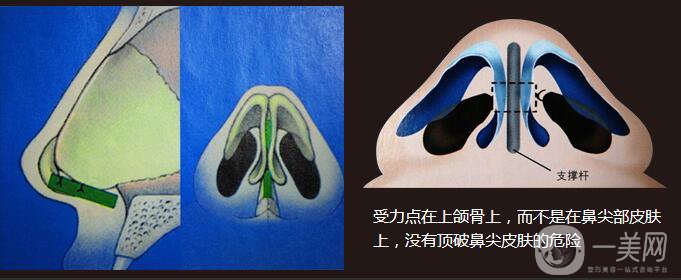 醫(yī)生測(cè)評(píng)：自體隆鼻專家 張笑天