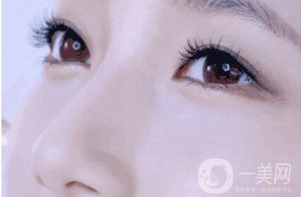 三點定位雙眼皮多少錢 雙眼皮手術(shù)方法