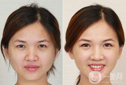 **價(jià)格 *瘦臉有副作用嗎