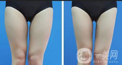 大腿抽脂方法,大腿抽脂注意事項(xiàng)