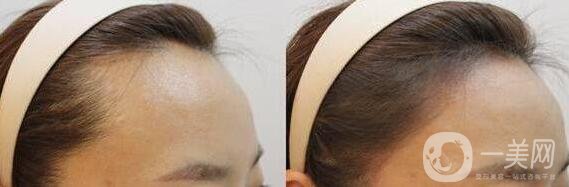 植發(fā),植發(fā)調節(jié)脫發(fā)好不好,植發(fā)調節(jié)脫發(fā)*果