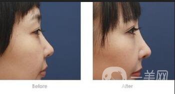 墊鼻梁,墊鼻梁術(shù)后注意什么,隆鼻術(shù)后護(hù)理