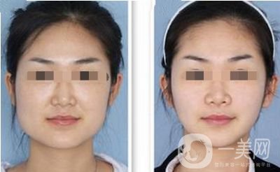 磨腮削骨多少錢 磨腮削骨*嗎