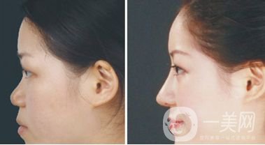 注射隆鼻前后圖 注射隆鼻如何護(hù)理