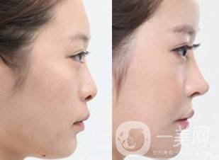 注射隆鼻前后圖 注射隆鼻如何護(hù)理