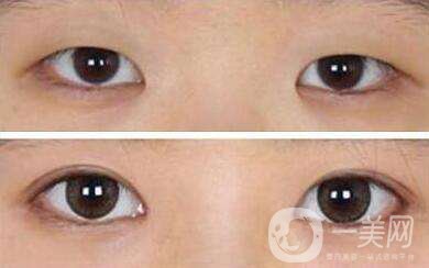 *前后 做雙眼皮有副作用嗎