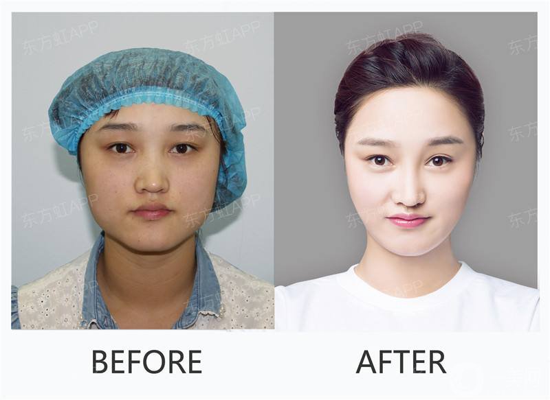 光子嫩膚的注意事項(xiàng) 光子嫩膚*果怎么樣