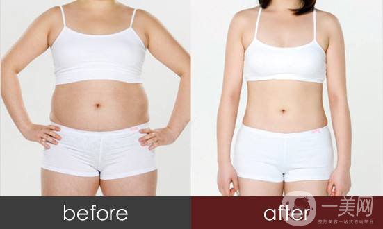 腰腹吸脂后多久*細 腰腹吸脂后注意事項