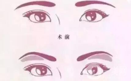 深圳假體豐眉弓手術費用 眉弓手術*嗎