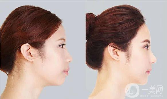 廣東耳軟骨加假體隆鼻價(jià)格是多少