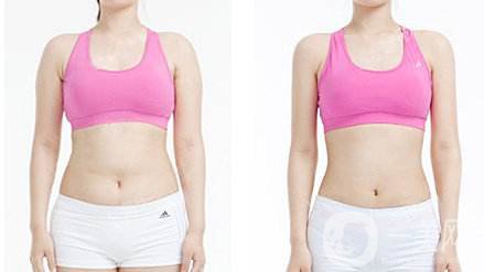 腰腹吸脂后怎樣保持 腰腹吸脂多久消腫