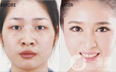 深圳墊鼻尖要多少錢 墊鼻尖*嗎