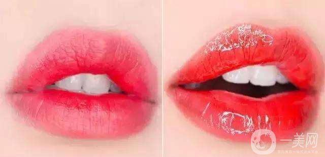 玻尿酸豐唇多少錢 豐唇方法有哪些