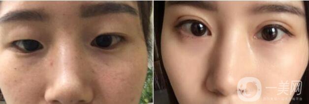 杭州割雙眼皮價格 割雙眼皮的方法