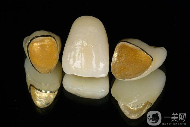 黃金烤瓷牙價(jià)格一般是多少？