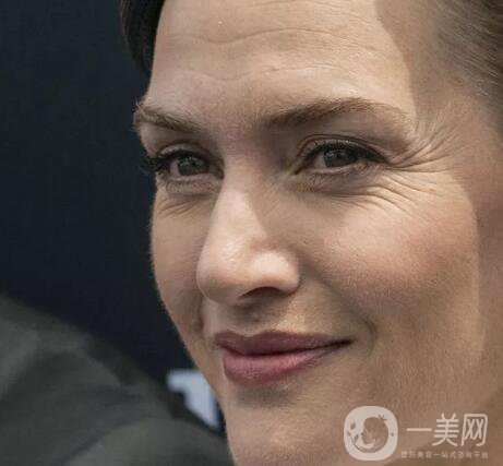 祛除眼角魚尾紋方法有哪些？價(jià)格一般是多少呢？