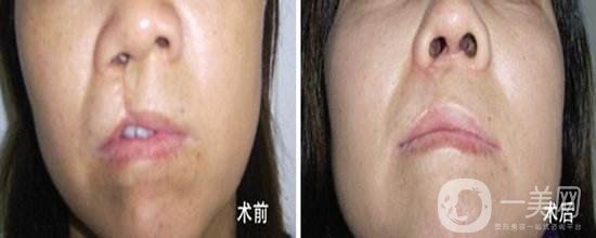 解放軍455整形外科隆胸手術(shù)做的怎么樣 