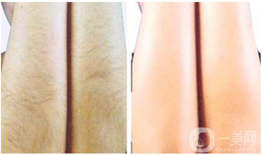 激光脫毛有什么好處？