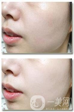 激光美容的激光有哪些類型