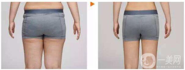 吸脂手術(shù)類型有哪些？